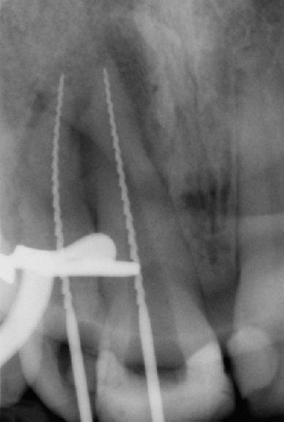 SD Swiss IRS Instrument Removal System Case Study—X-Ray showing the working length