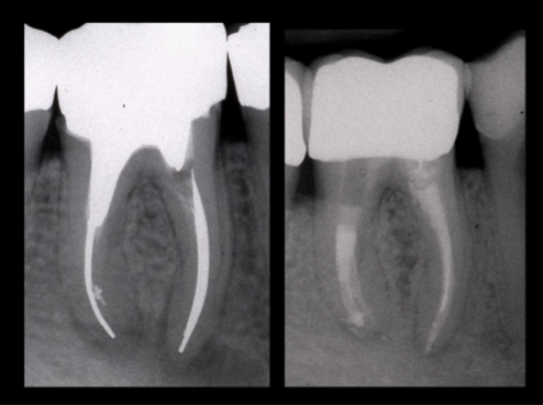 Endodontic Case 1: Complex Retreatment using the INDY-300 Diamond Retreatment Tip, the IRS® Instrument Removal System and the INDY-600 Diamond Retreatment Tip by Dott. Alberto Rieppi
