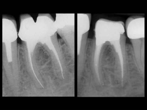 Endodontic Case 2: Retreatment using the INDY-400 Diamond Retreatment Tip, the IRS® Instrument Removal System and the INDY-600 Diamond Retreatment Tip by Dott. Alberto Rieppi